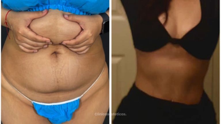 Abdominoplastia - Dr. Zamir Páez