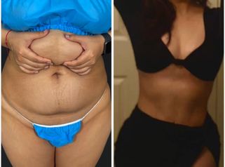 Abdominoplastia - Dr. Zamir Páez