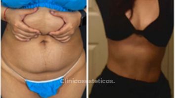 Abdominoplastia - Dr. Zamir Páez