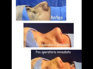 Rinoplastia - Dr. Hugo Javier Mejía Cuello