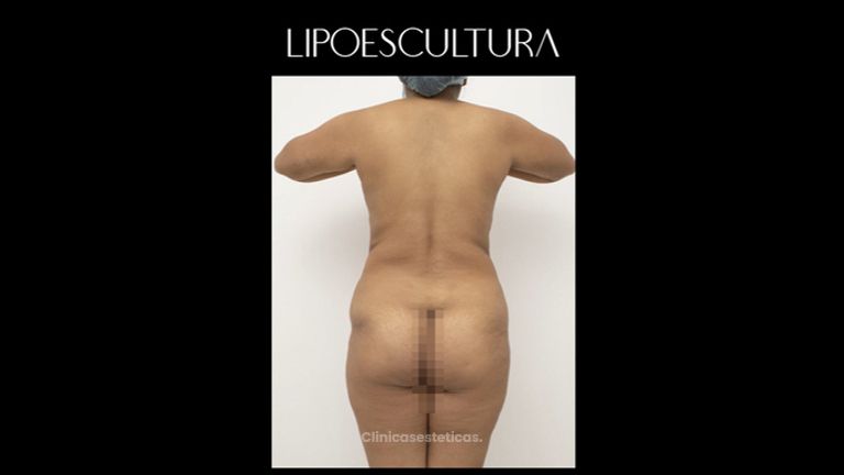 Liposucción - Dr. Luis Fernando Reyes & Dra. Nicole Echeverry