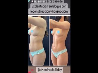 Liposucción - Dra. Andrea Halliday Rueda