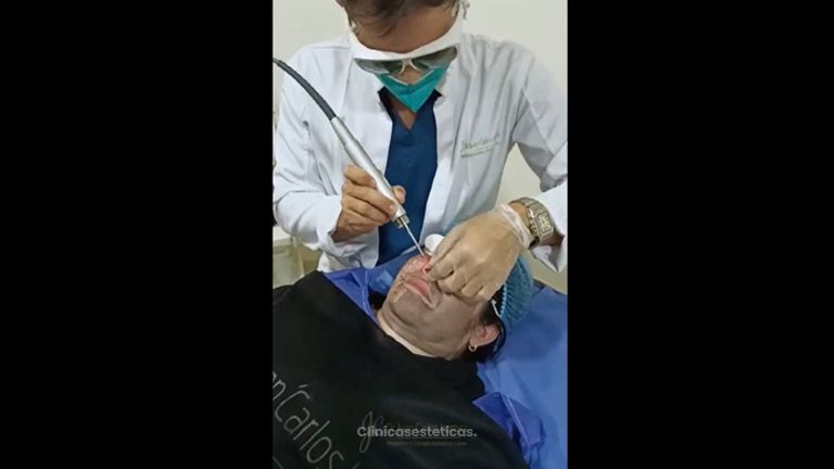 Peeling - Dr. Juan Carlos Herrera P.