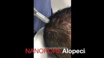 Alopecia