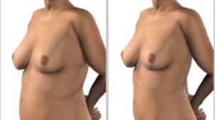 Cómo se realiza la liposcción