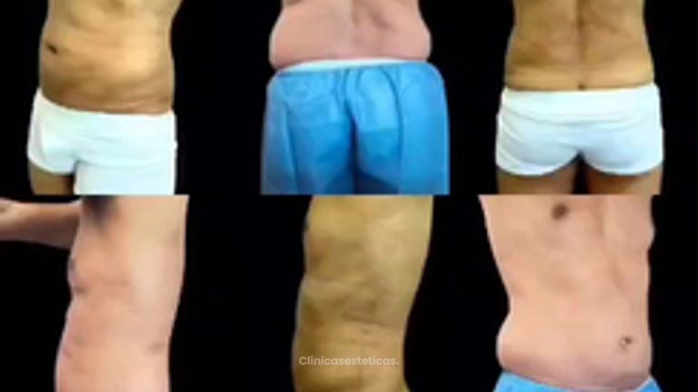 Lipoescultura Masculina - Dra. Ángeles Esmeral