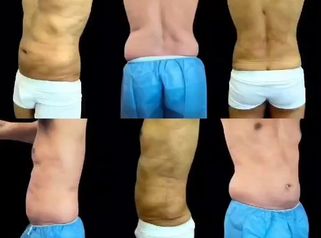 Lipoescultura Masculina - Dra. Ángeles Esmeral