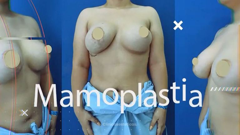 Mamoplastia de aumento - Dr. Victor Hugo Quevedo