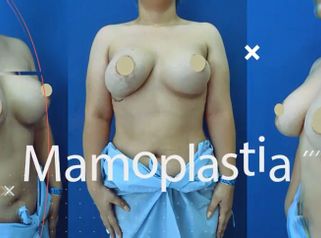 Mamoplastia de aumento - Dr. Victor Hugo Quevedo