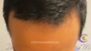 Implantes de cabello - Dra. Lady Mora y Dr. Juan Felipe Acosta