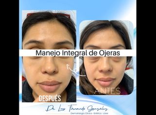 Eliminación de las ojeras