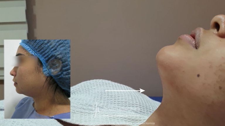 Liposucción de papada + Bichectomia - Dr. Juan Carlos Herrera P.