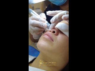 Rejuvenecimiento facial - Dr. Juan Carlos Herrera P.