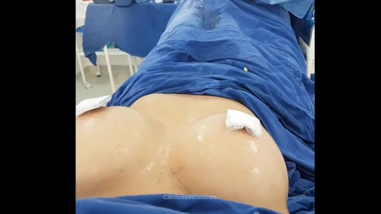 Mamoplastia de aumento
