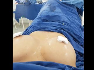 Mamoplastia de aumento 