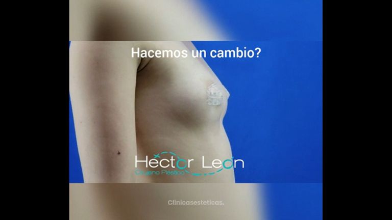 Mamoplastia de aumento 