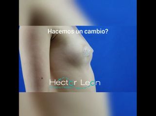 Mamoplastia de aumento 