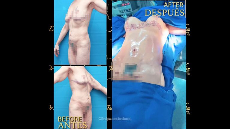 Mamoplastia de aumento - Dr. Jaime Pachón