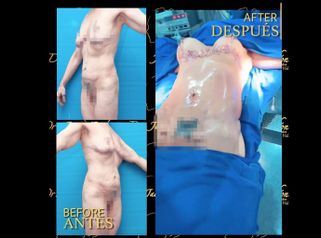 Mamoplastia de aumento - Dr. Jaime Pachón