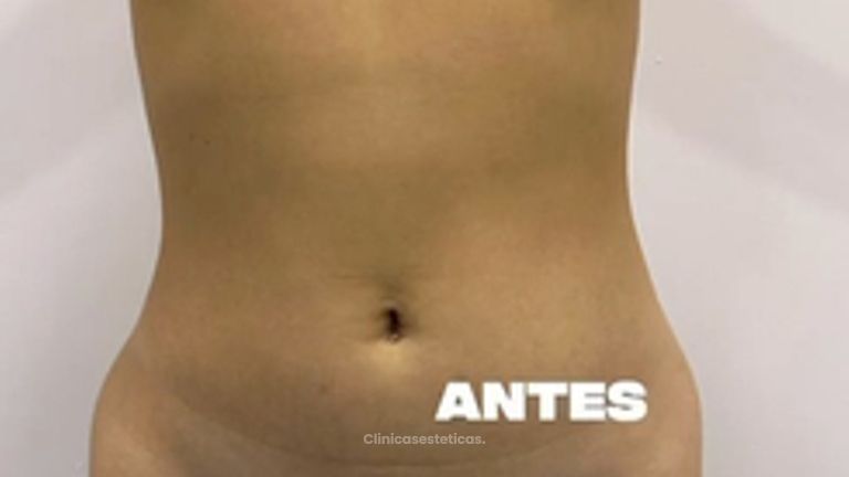 Lipoescultura HD + Mamoplastia de aumento - Clínica Vivir