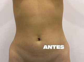 Lipoescultura HD + Mamoplastia de aumento - Clínica Vivir
