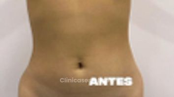 Lipoescultura HD + Mamoplastia de aumento - Clínica Vivir