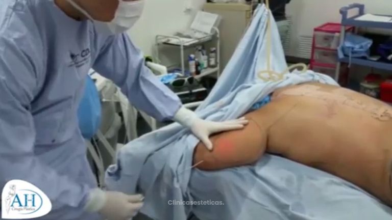 Elimina la grasa de tu cuerpo con láser