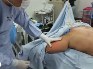 Elimina la grasa de tu cuerpo con láser