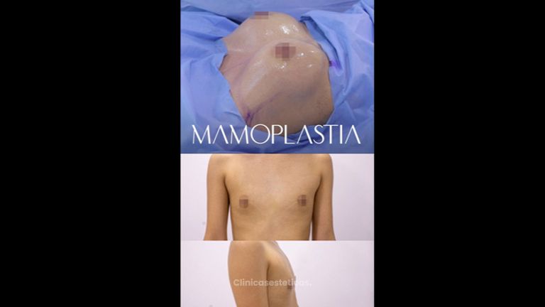 Mamoplastia de aumento - Dr. Luis Fernando Reyes & Dra. Nicole Echeverry