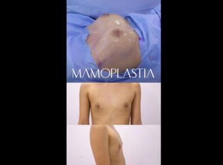Mamoplastia de aumento - Dr. Luis Fernando Reyes & Dra. Nicole Echeverry