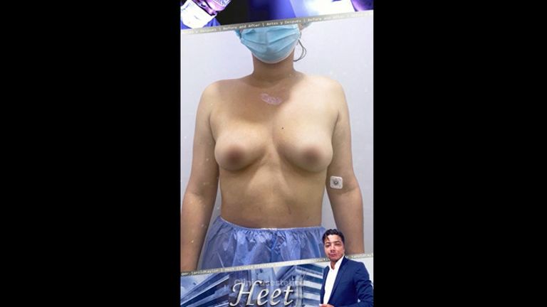 Mamoplastia de aumento - Dr. Jarold Effer Taylor