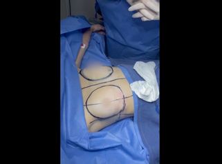 Levantamiento de senos - Dr. Yamen Chaer Rafeh