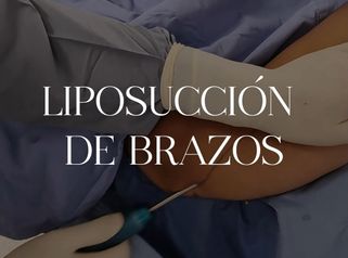 Lipoescultura - Dra. Ángeles Esmeral