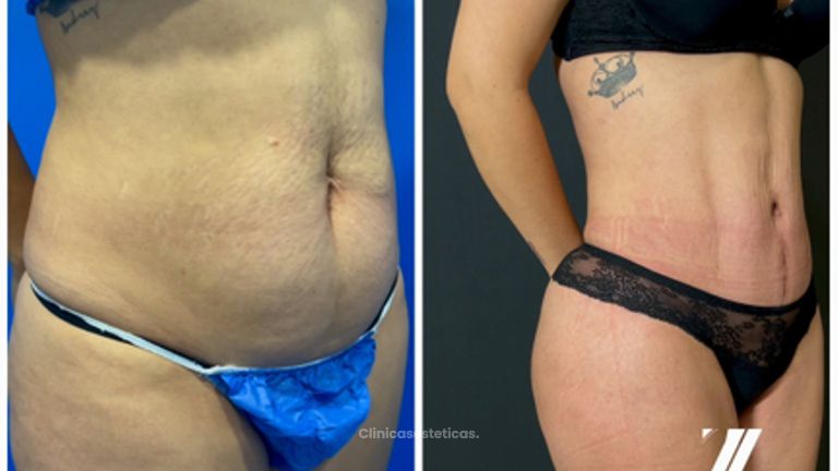 Abdominoplastia - Dr. Zamir Páez