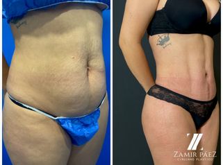 Abdominoplastia - Dr. Zamir Páez