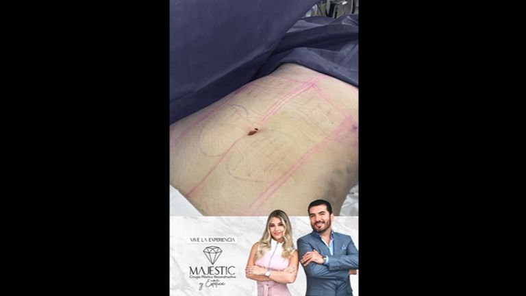 Liposucción - Dra. Nicole Echeverry y Dr. Luis Fernando Reyes
