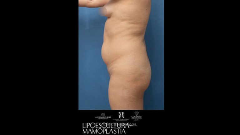 Lipoescultura - Dr. Luis Fernando Reyes y Dra. Nicole Echeverry