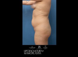 Lipoescultura - Dr. Luis Fernando Reyes y Dra. Nicole Echeverry