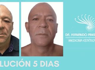 Blefaroplastia - Dr. Fernando Pinedo Bischoff