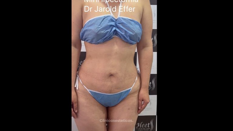 Minilipectomia - Dr. Jarold Effer Taylor