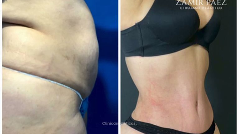 Abdominoplastia - Dr. Zamir Páez