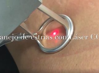 Manejo de estrias con laser CO2