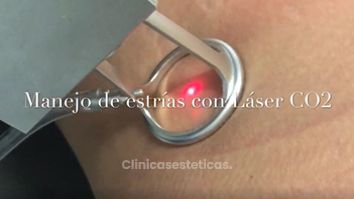 Manejo de estrias con laser CO2