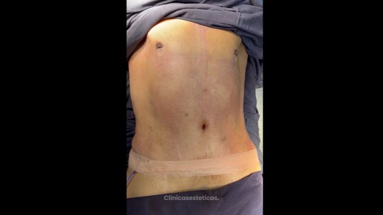 Abdominoplastia - Dra. Mariana Ríos