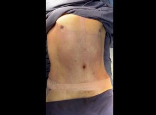 Abdominoplastia - Dra. Mariana Ríos