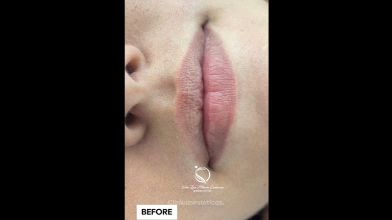 Aumento de labios - Dra. Luz María Cañavera