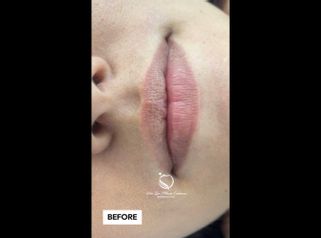 Aumento de labios - Dra. Luz María Cañavera