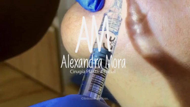 Relleno de Surcos - Doctora Alexandra Mora