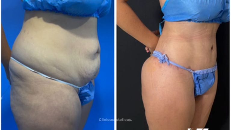 Abdominoplastia - Dr. Zamir Páez