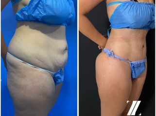 Abdominoplastia - Dr. Zamir Páez